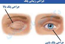 بلفاروپلاستی |جراحی زیبایی