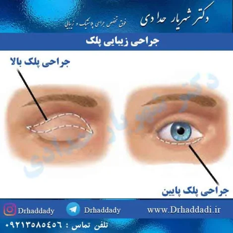 بلفاروپلاستی