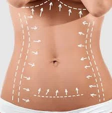 Back pain after Abdo operation