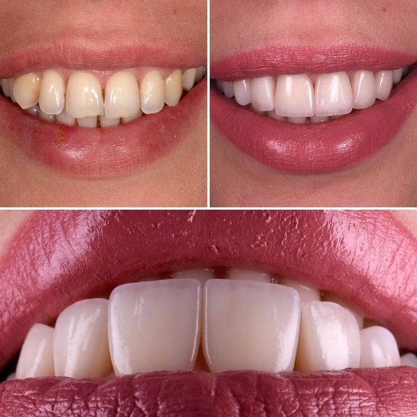 Teeth whitening at home