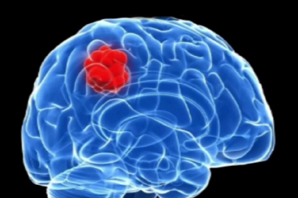 یک داروی موثر در درمان سرطان مغز