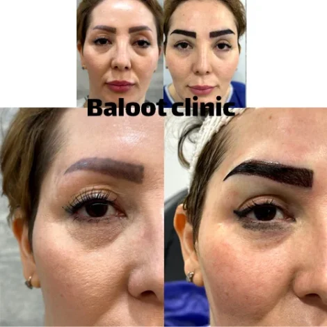 کاشت ابرو