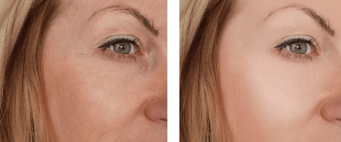 پوست |پوست خشک